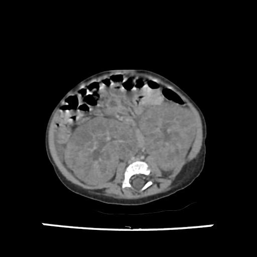 Caroli disease with autosomal recessive polycystic kidney disease (ARPKD) (Radiopaedia 89651-106703 B 141).jpg