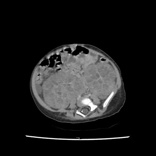 Caroli disease with autosomal recessive polycystic kidney disease (ARPKD) (Radiopaedia 89651-106703 B 151).jpg