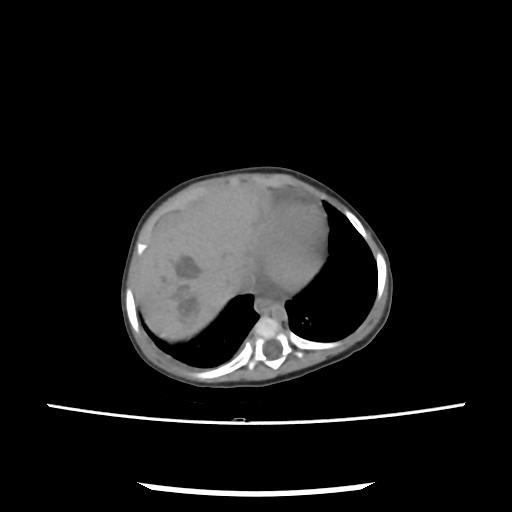 Caroli disease with autosomal recessive polycystic kidney disease (ARPKD) (Radiopaedia 89651-106703 E 17).jpg