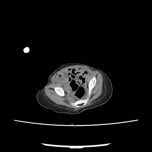 Caroli disease with autosomal recessive polycystic kidney disease (ARPKD) (Radiopaedia 89651-106703 E 205).jpg