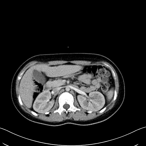 Caroli disease with medullary sponge kidney (Radiopaedia 82622-96804 C 27).jpg