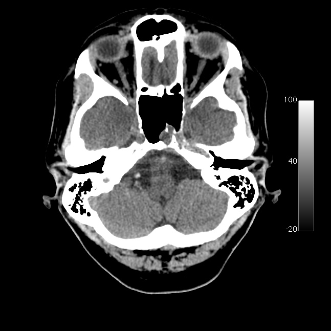 Caroticocavernous fistula (Radiopaedia 14617-14542 Axial non-contrast 5).jpg