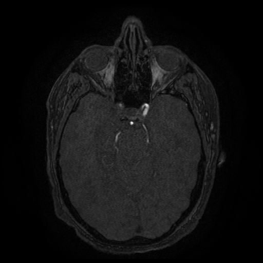 File:Carotid arterial dissection with acute cerebral infarction (Radiopaedia 26636-26784 MRA 108).jpg
