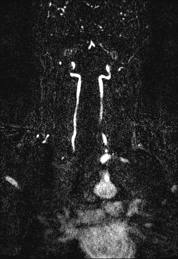 File:Carotid artery dissection (Radiopaedia 28441-28689 Coronal MRA 57).jpg