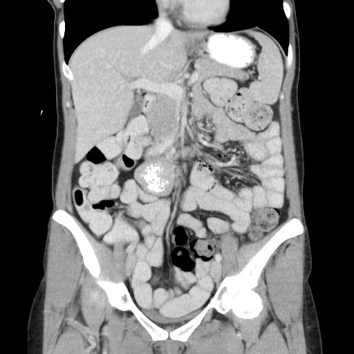 Castleman disease with fibrous pseudotumor in the abdomen (Radiopaedia 77296-89373 B 40).jpg