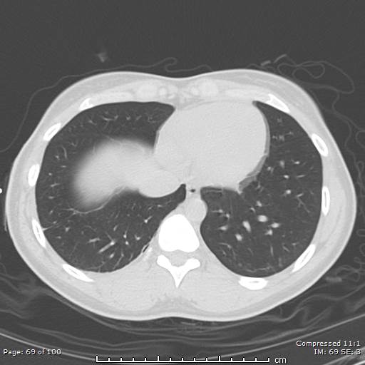 Catamenial pneumothorax (Radiopaedia 54382-60600 Axial non-contrast 69).jpg