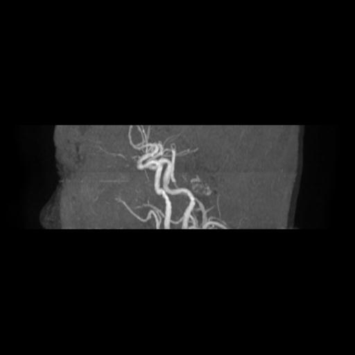 Cavernoma with developmental venous anomaly (Radiopaedia 22470-22507 MRA 2).jpg