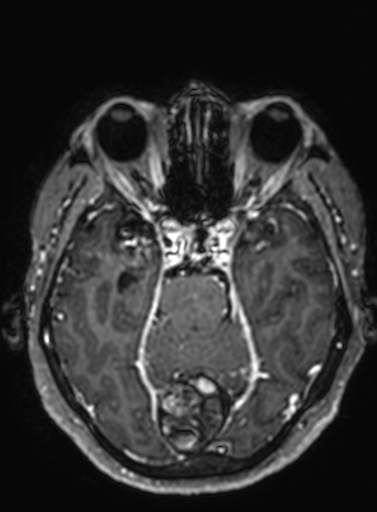 Cavernous hemangioma of the cerebellar falx (Radiopaedia 73025-83724 Axial T1 C+ 221).jpg