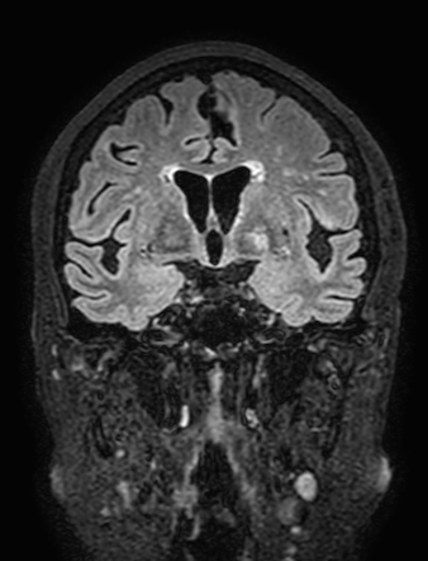 Cavernous hemangioma of the cerebellar falx (Radiopaedia 73025-83724 Coronal FLAIR 150).jpg