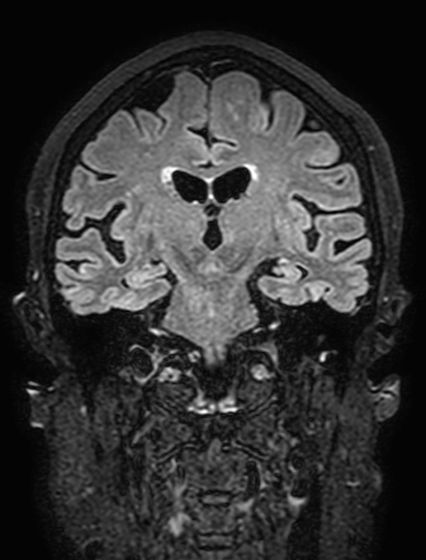 Cavernous hemangioma of the cerebellar falx (Radiopaedia 73025-83724 Coronal FLAIR 186).jpg
