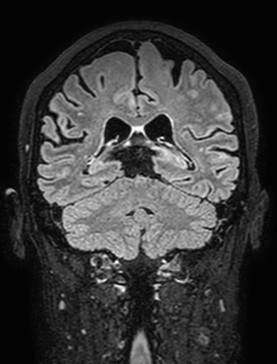 Cavernous hemangioma of the cerebellar falx (Radiopaedia 73025-83724 Coronal FLAIR 229).jpg