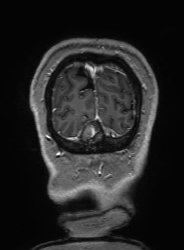 Cavernous hemangioma of the cerebellar falx (Radiopaedia 73025-83724 Coronal T1 C+ 349).jpg