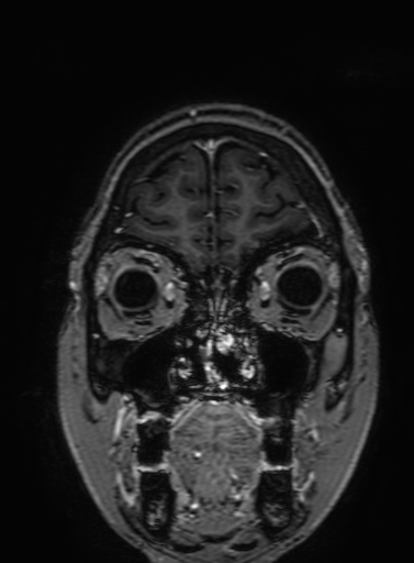 Cavernous hemangioma of the cerebellar falx (Radiopaedia 73025-83724 Coronal T1 C+ 57).jpg