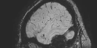 Cavernous hemangioma of the cerebellar falx (Radiopaedia 73025-83724 Sagittal BOLD 177).jpg