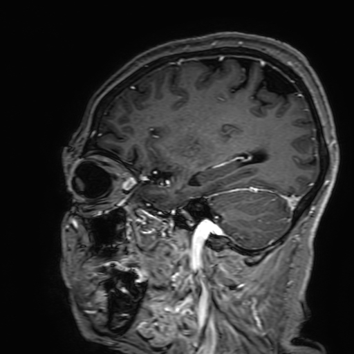 File:Cavernous hemangioma of the cerebellar falx (Radiopaedia 73025-83724 Sagittal T1 C+ 152).jpg