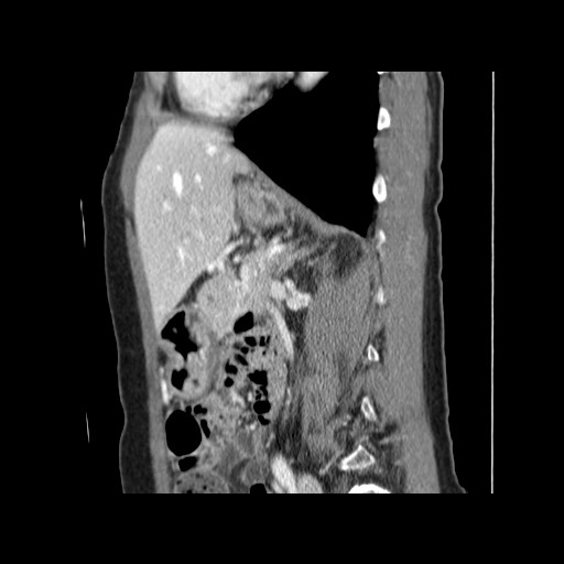 Cavernous hepatic hemangioma (Radiopaedia 75441-86667 D 121).jpg