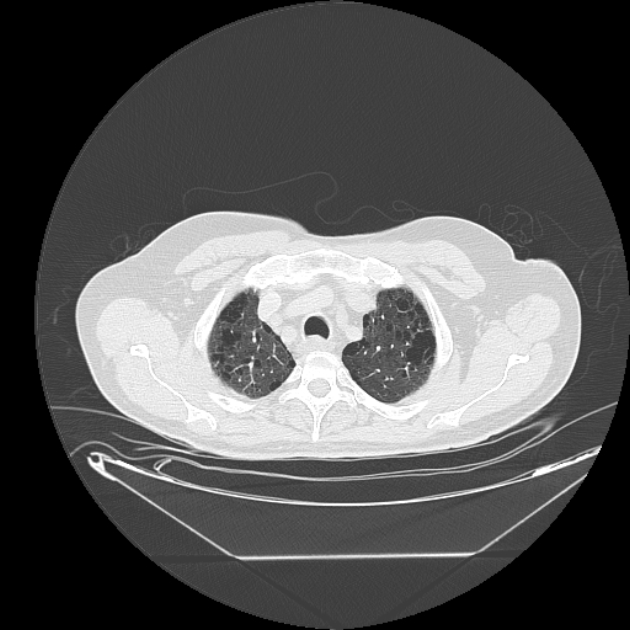Cavitating bronchogenic carcinoma (Radiopaedia 44489-48162 Axial lung window 10).jpg