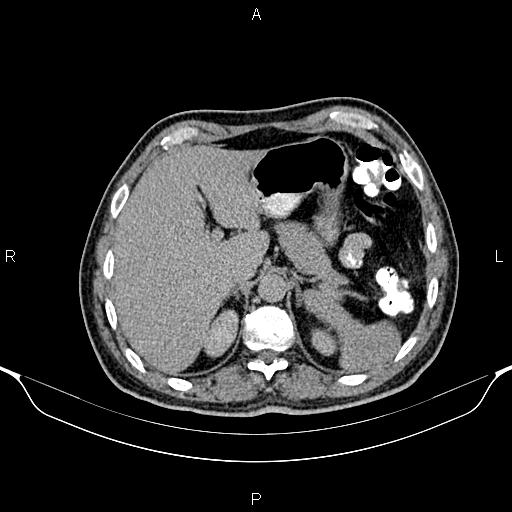 Cecal adenocarcinoma (Radiopaedia 85324-100916 Axial C+ delayed 22).jpg