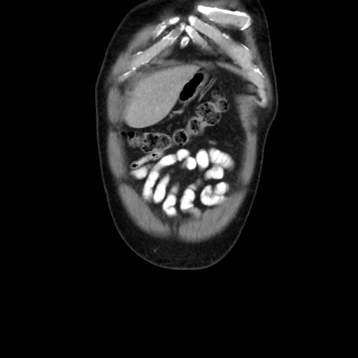 Cecal mass causing appendicitis (Radiopaedia 59207-66531 B 5).jpg