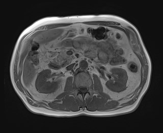 Cecal mass causing appendicitis (Radiopaedia 59207-66532 Axial T1 in-phase 58).jpg