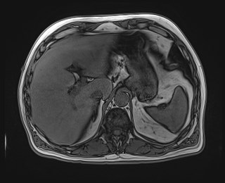 Cecal mass causing appendicitis (Radiopaedia 59207-66532 D 34).jpg
