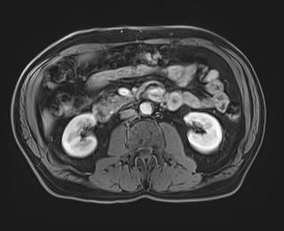 Cecal mass causing appendicitis (Radiopaedia 59207-66532 T1 C+ PV phase 66).jpg