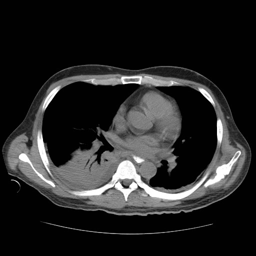 Cecal volvulus (Radiopaedia 28294-28534 Axial non-contrast 2).jpg