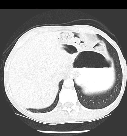 File:Cecal volvulus (Radiopaedia 48543-53513 Axial lung window 15).jpg