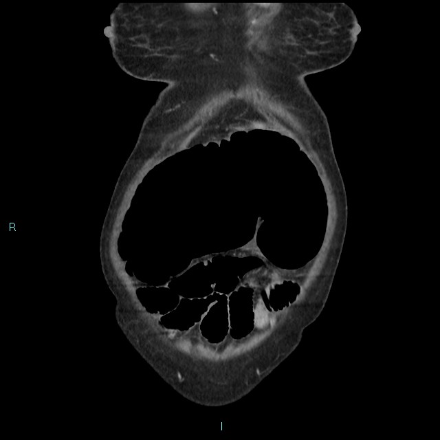 Cecal volvulus (Radiopaedia 71372-81698 C 18).jpg