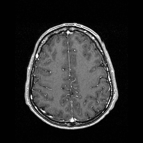 Central-variant posterior reversible encephalopathy syndrome (PRES) (Radiopaedia 43880-47358 Axial T1 C+ 125).jpg