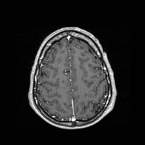 File:Central-variant posterior reversible encephalopathy syndrome (PRES) (Radiopaedia 43880-47358 Axial T1 C+ 136).jpg