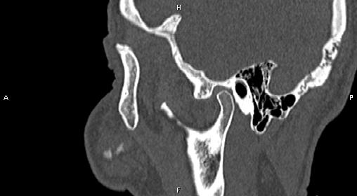 File:Central giant cell granuloma (Radiopaedia 83346-97761 Sagittal bone window 8).jpg