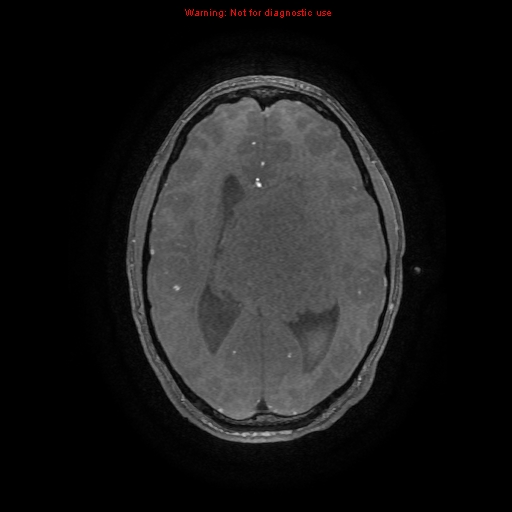 Central neurocytoma (Radiopaedia 13188-13206 Axial MRA 16).jpg