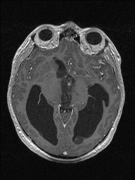 Central neurocytoma (Radiopaedia 56690-63469 Axial T1 C+ 69).jpg