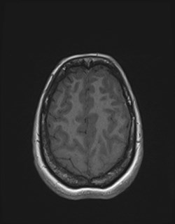 Central neurocytoma (Radiopaedia 84497-99872 Axial T1 159).jpg
