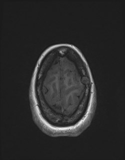 Central neurocytoma (Radiopaedia 84497-99872 Axial T1 169).jpg