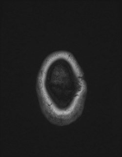 File:Central neurocytoma (Radiopaedia 84497-99872 Axial T1 179).jpg