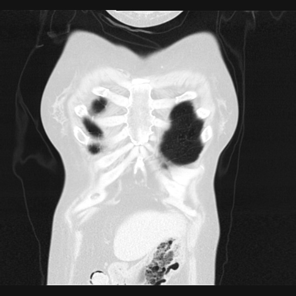 Centrilobular pulmonary emphysema (Radiopaedia 24495-24789 Coronal lung window 5).jpg