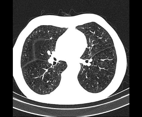 Centrilobular pulmonary emphysema (Radiopaedia 62468-70718 Axial lung window 43).jpg
