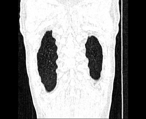 Centrilobular pulmonary emphysema (Radiopaedia 62468-70718 Coronal lung window 68).jpg