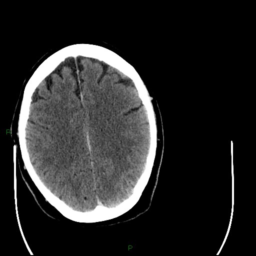 Cerebellar abscess (Radiopaedia 78135-90671 Axial C+ delayed 74).jpg