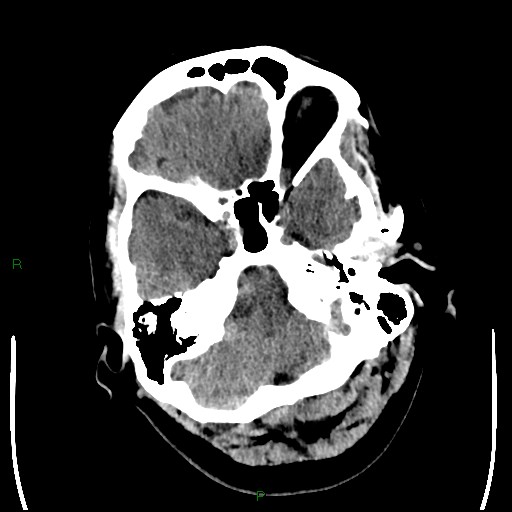 File:Cerebellar abscess (Radiopaedia 78135-90671 Axial non-contrast 24).jpg