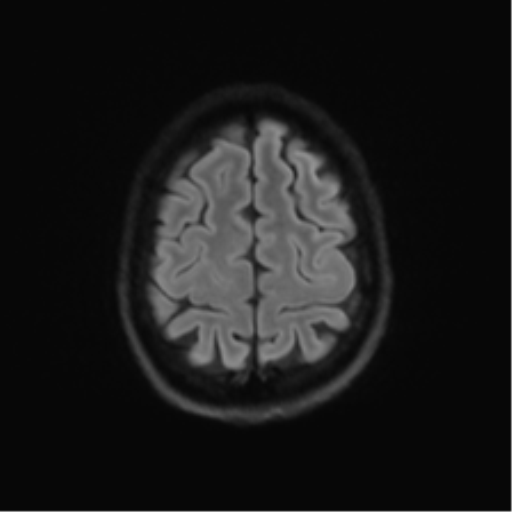 Cerebellar agenesis with hypoplastic pons (pontocerebellar hypoplasia) (Radiopaedia 57224-64138 Axial DWI 68).png