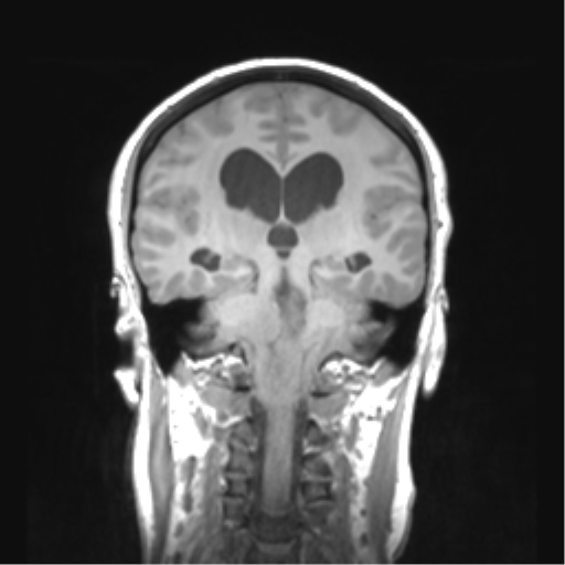 Cerebellar ependymoma complicated by post-operative subdural hematoma (Radiopaedia 83322-97736 Coronal T1 33).png