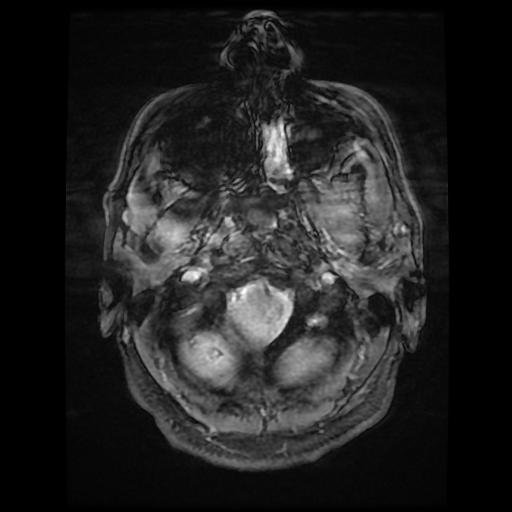 File:Cerebellar hemangioblastoma (Radiopaedia 88055-104622 Axial Gradient Echo 2).jpg