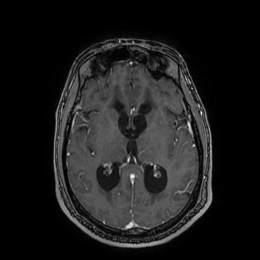 File:Cerebellar hemangioblastoma (Radiopaedia 88055-104622 Axial T1 C+ 97).jpg