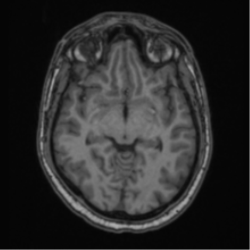 Cerebellar hemangioblastomas and pituitary adenoma (Radiopaedia 85490-101176 Axial T1 33).png