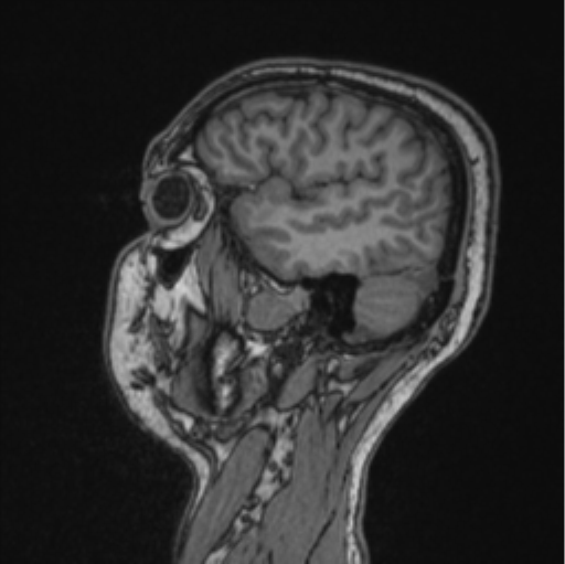 Cerebellar hemangioblastomas and pituitary adenoma (Radiopaedia 85490-101176 Sagittal T1 74).png
