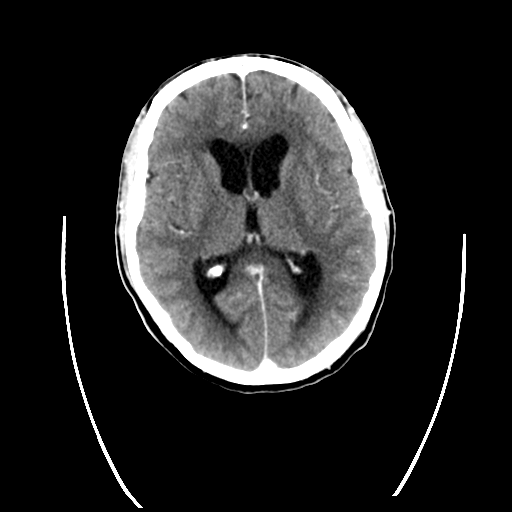 File:Cerebellar hemorrhage (Radiopaedia 37000-38671 Sagittal C+ 1).png