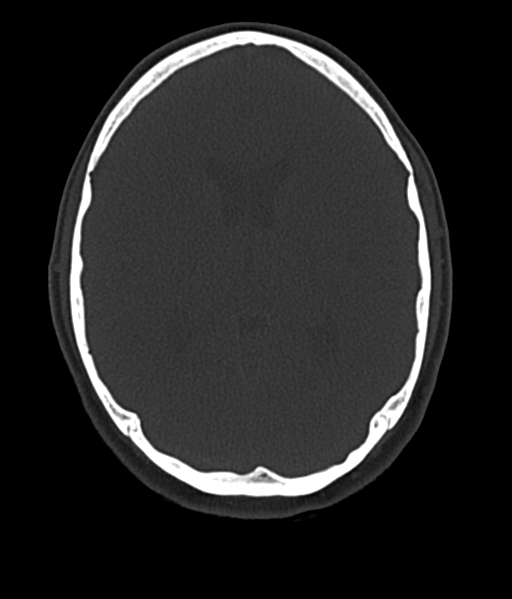 File:Cerebellar metastases - colorectal adenocarcinoma (Radiopaedia 40947-43652 AX Bone C- 2.0 MPR 33).png